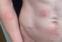 EUA emitem alerta sobre fungo sexualmente transmissível e preocupa autoridades